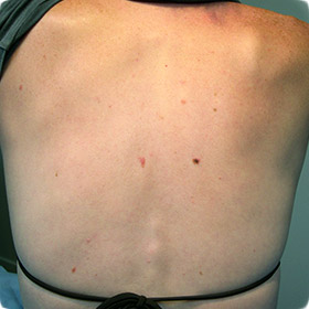 A back with moles